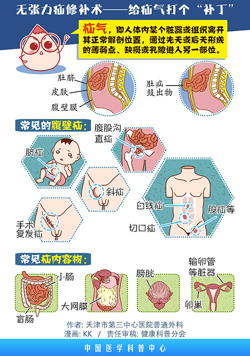 画说:疝气的外科治疗——无张力疝修补术