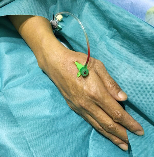 冠脉介入新途径我院心脏中心开展远端桡动脉穿