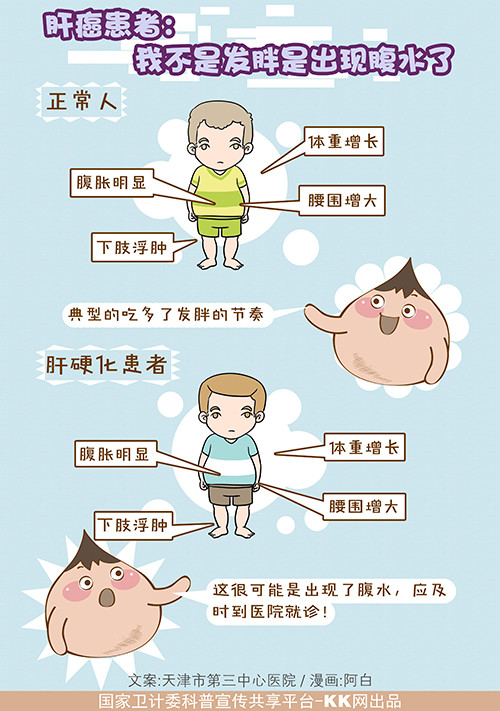 肝硬化腹水的治疗