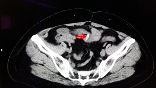 误吞枣核致肠穿孔,普外科及时微创手术治愈
