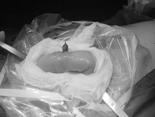 误吞枣核致肠穿孔,普外科及时微创手术治愈