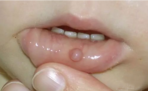 口腔科副主任高金波:口腔内水疱,当心是黏液囊肿