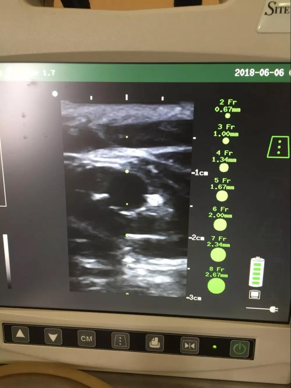 血液科成功开展picc置管术