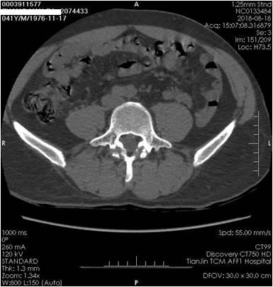 骨伤科开展腰椎间盘突出症的椎弓根钉棒 cage植骨融合术